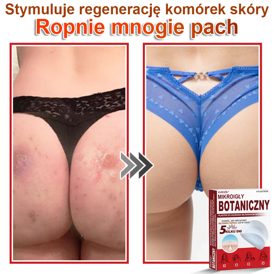 KUBOZN® Mikroigłowy botaniczny środek do usuwania narośli skórnych ✅✅✅wyprodukowano w Polsce
