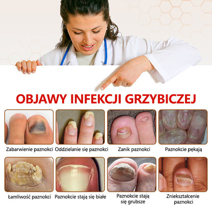 Spray z jadem pszczelim – skuteczny w leczeniu infekcji grzybiczych i zapalenia paznokci🎁🎁