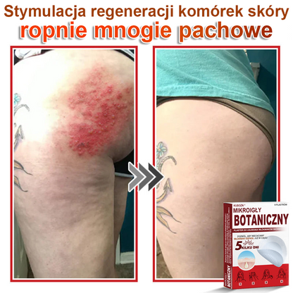 KUBOZN® Mikroigłowy botaniczny środek do usuwania narośli skórnych ✅✅✅wyprodukowano w Polsce