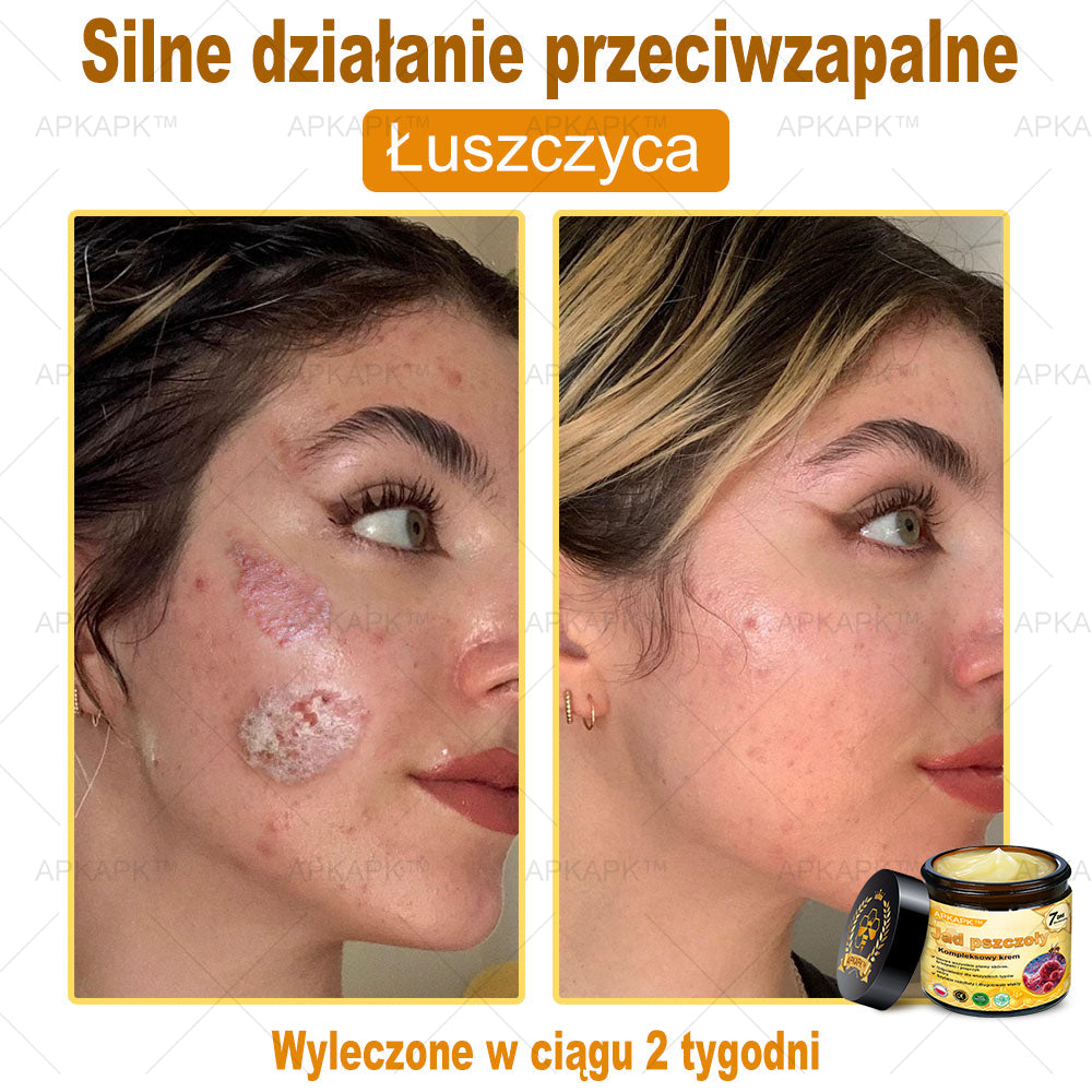ΑPΚΑPK™ Jad Pszczoły Kompleksowy Krem🥇🥇pomaga w leczeniu problemów skórnych, takich jak: zmarszczki, blizny, plamy pigmentacyjne, rozstępy, trądzik, łuszczyca, egzema, zmiany skórne, podrażnienia, stany zapalne i inne problemy skórne🔥🔥🔥