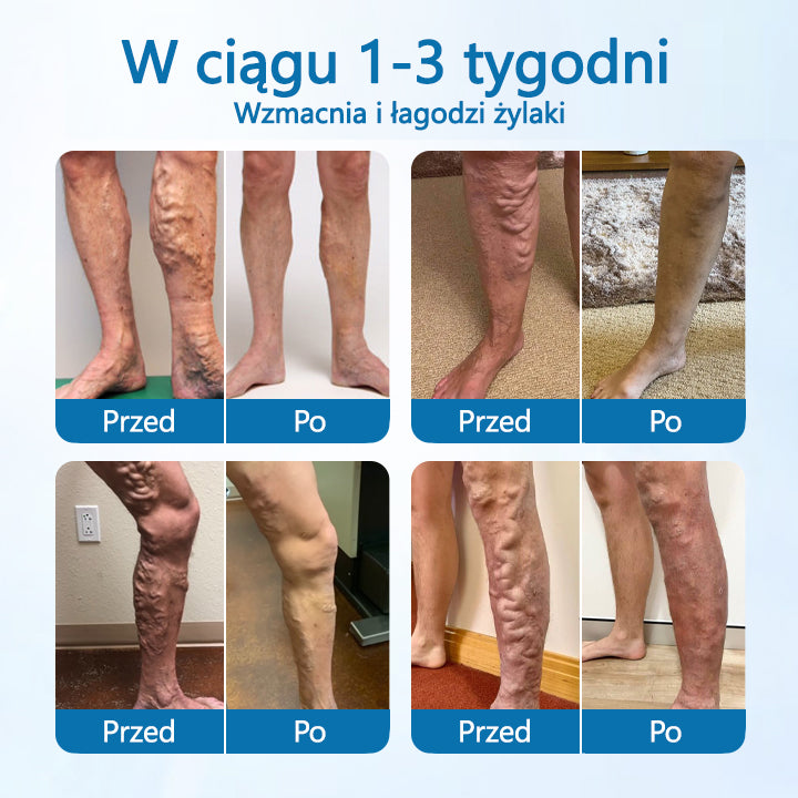 Timilk® VeinGuard Herbal Spray-✅ Klinicznie udowodniono, że eliminuje żylaki w zaledwie 7 dni!