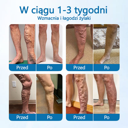 Timilk® VeinGuard Herbal Spray-✅ Klinicznie udowodniono, że eliminuje żylaki w zaledwie 7 dni!