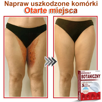 KUBOZN® Mikroigłowy botaniczny środek do usuwania narośli skórnych ✅✅✅wyprodukowano w Polsce