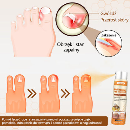 Spray z jadem pszczelim – skuteczny w leczeniu infekcji grzybiczych i zapalenia paznokci🎁🎁