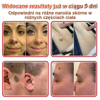 KUBOZN® Mikroigłowy botaniczny środek do usuwania narośli skórnych ✅✅✅wyprodukowano w Polsce