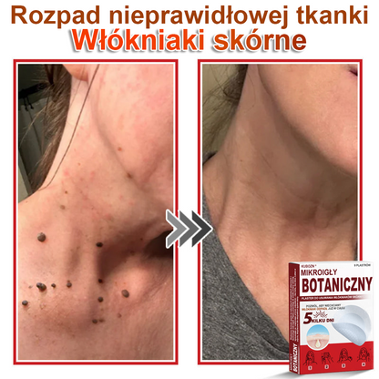 KUBOZN® Mikroigłowy botaniczny środek do usuwania narośli skórnych ✅✅✅wyprodukowano w Polsce