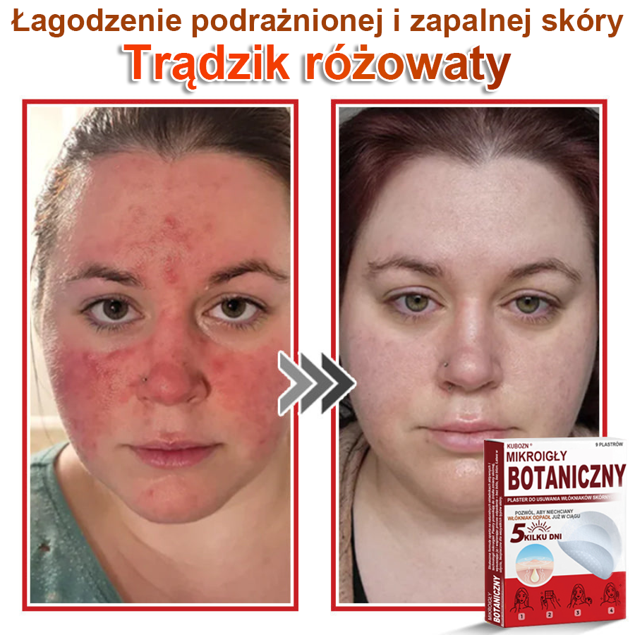 KUBOZN® Mikroigłowy botaniczny środek do usuwania narośli skórnych ✅✅✅wyprodukowano w Polsce