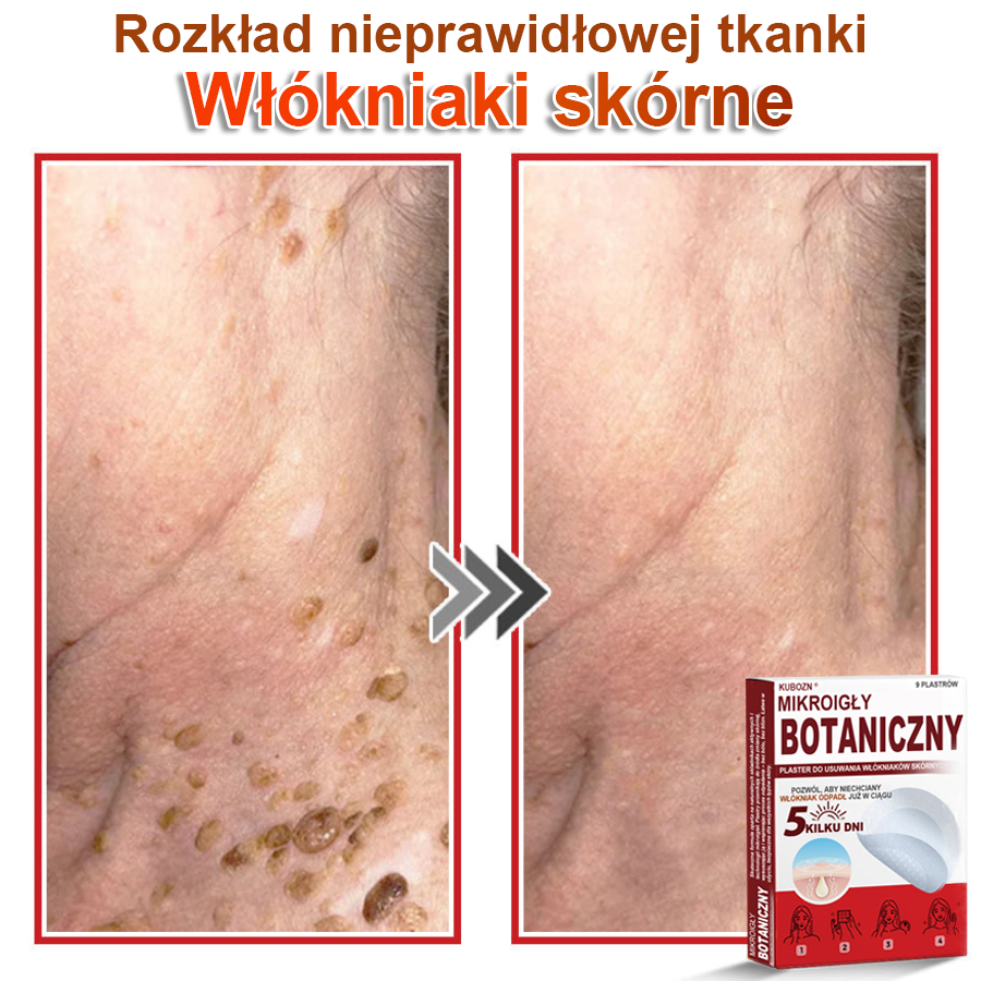 KUBOZN® Mikroigłowy botaniczny środek do usuwania narośli skórnych ✅✅✅wyprodukowano w Polsce