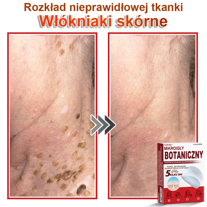 KUBOZN® Mikroigłowy botaniczny środek do usuwania narośli skórnych ✅✅✅wyprodukowano w Polsce