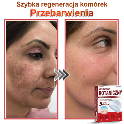 KUBOZN® Mikroigłowy botaniczny środek do usuwania narośli skórnych ✅✅✅wyprodukowano w Polsce